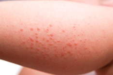 naet-allergie-huid